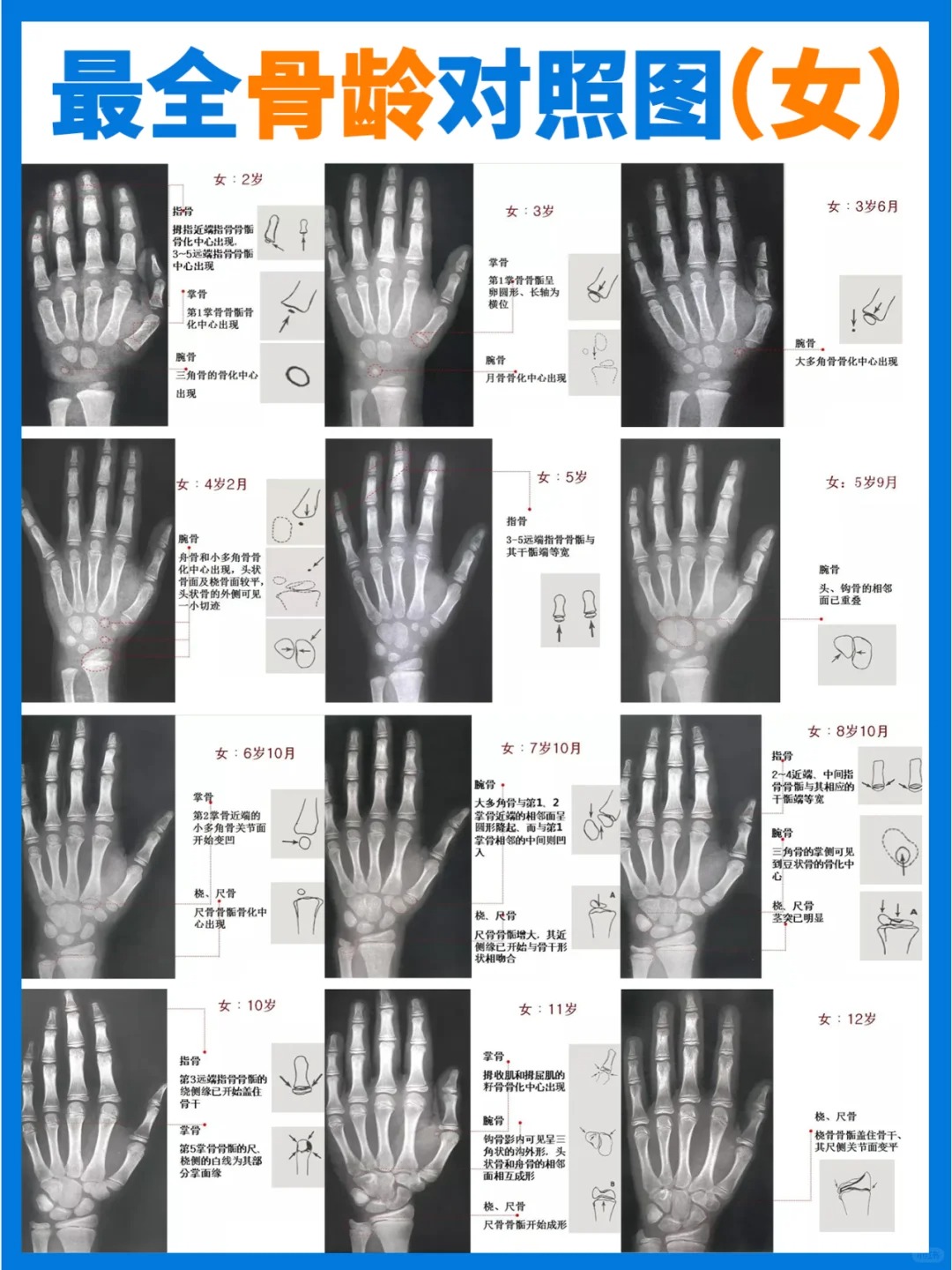 骨龄简单来说就是骨骼的年龄它可是孩子生长发育的小小晴雨表