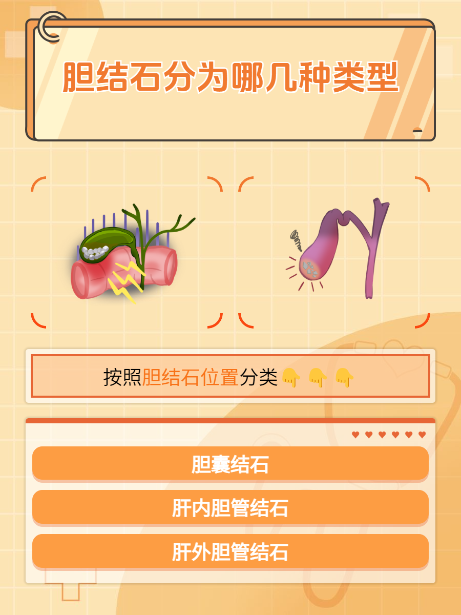 胆道系统是由胆囊和胆管组成,结石可发生在胆道任何部位.