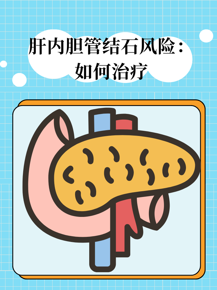 肝内胆管结石风险:如何治疗 肝内胆管结石,这个听起来有些陌生的名词