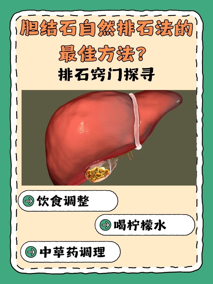 胆结石自然排石,可通过饮食和运动