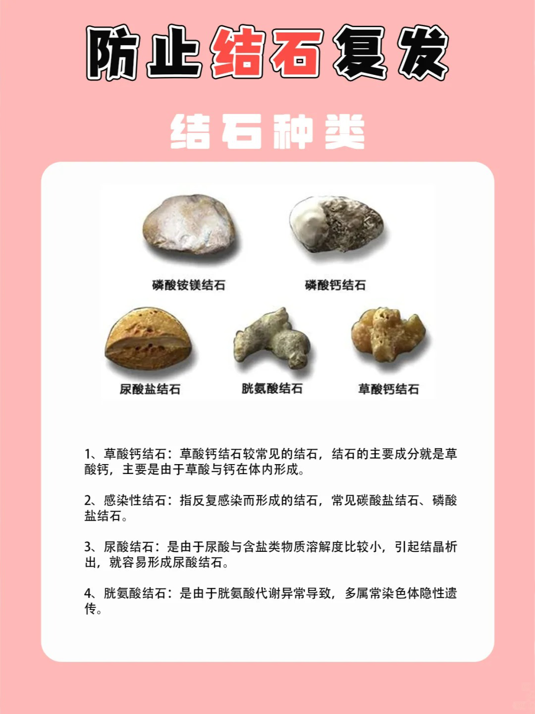 尿结石严重吗图片