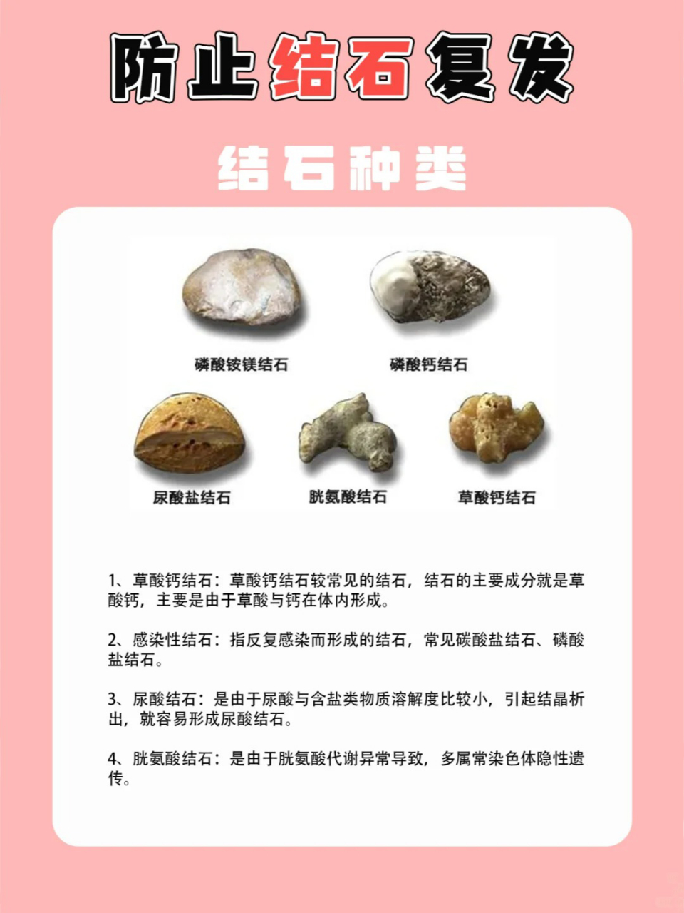 结石的种类图片