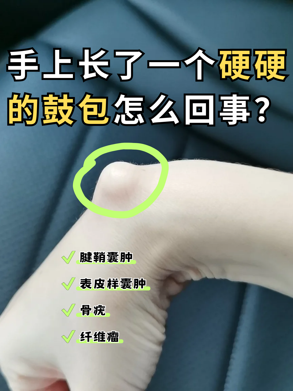手上长了一个硬硬的鼓包怎么回事?