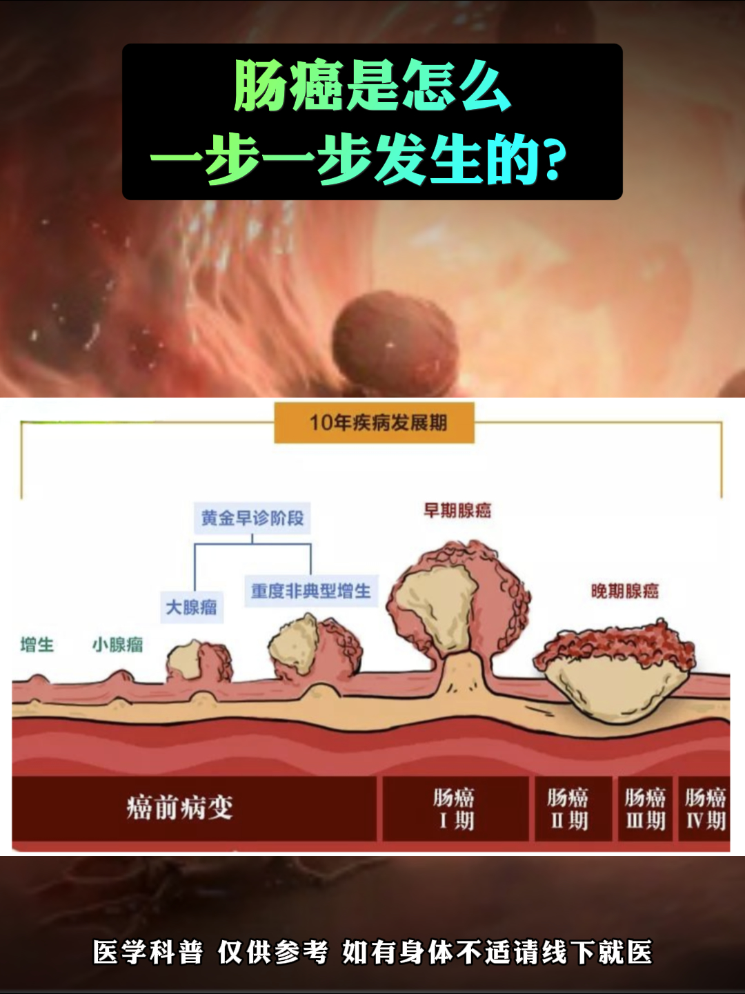 肿瘤形成过程肠息肉演变成癌症过程图肠癌发展过程癌变过程肠癌发展
