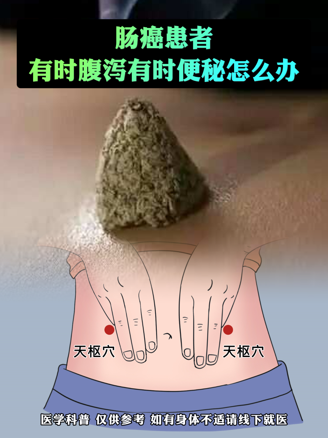 大家知道天枢穴吗?在肚脐旁开两寸,一左一右.天枢穴为