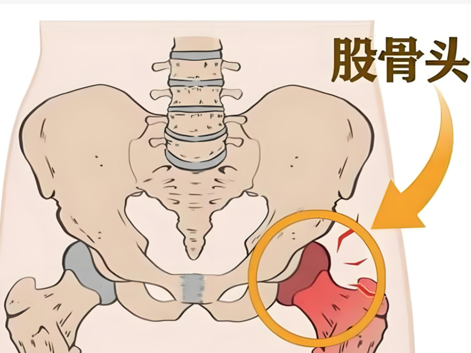 髋关节隐痛,活动受限,甚至连走路都成困难?