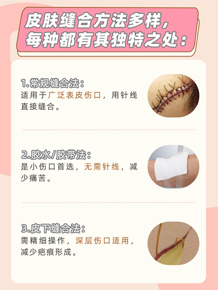 伤口缝合秘籍:一文读懂皮肤缝合有几种方法