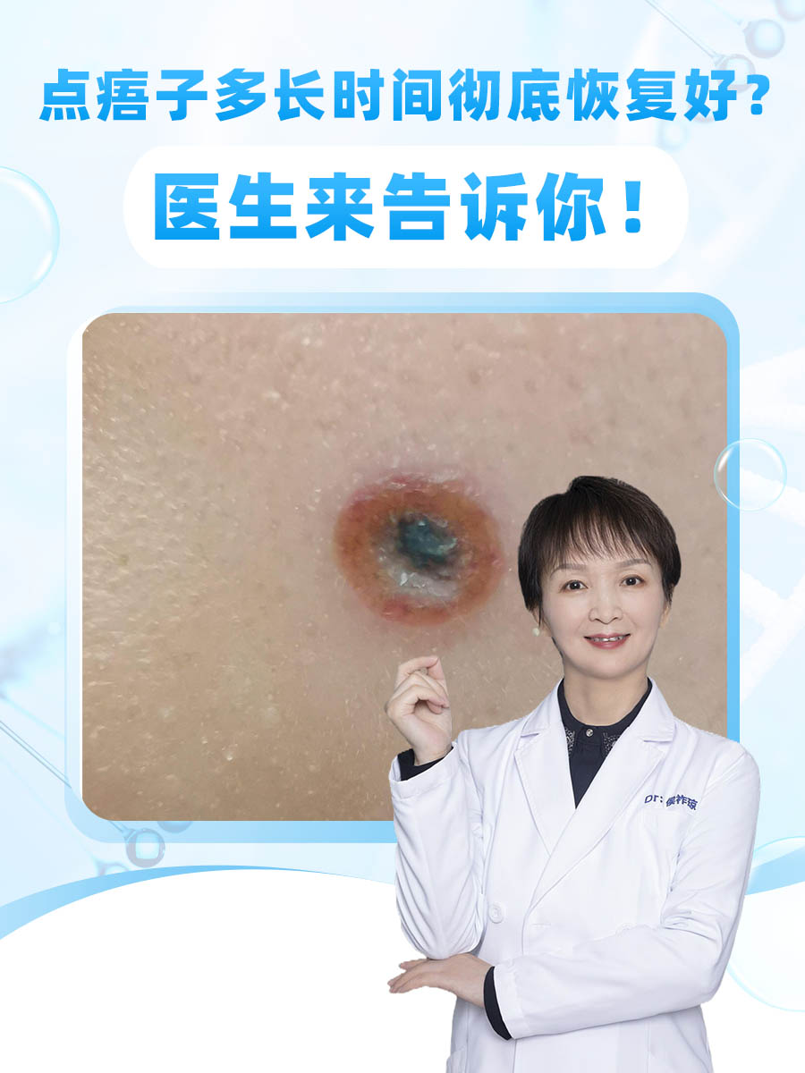 点痦子,也就是我们通常所说的去除色素痣,是许多人为了美容而选择的