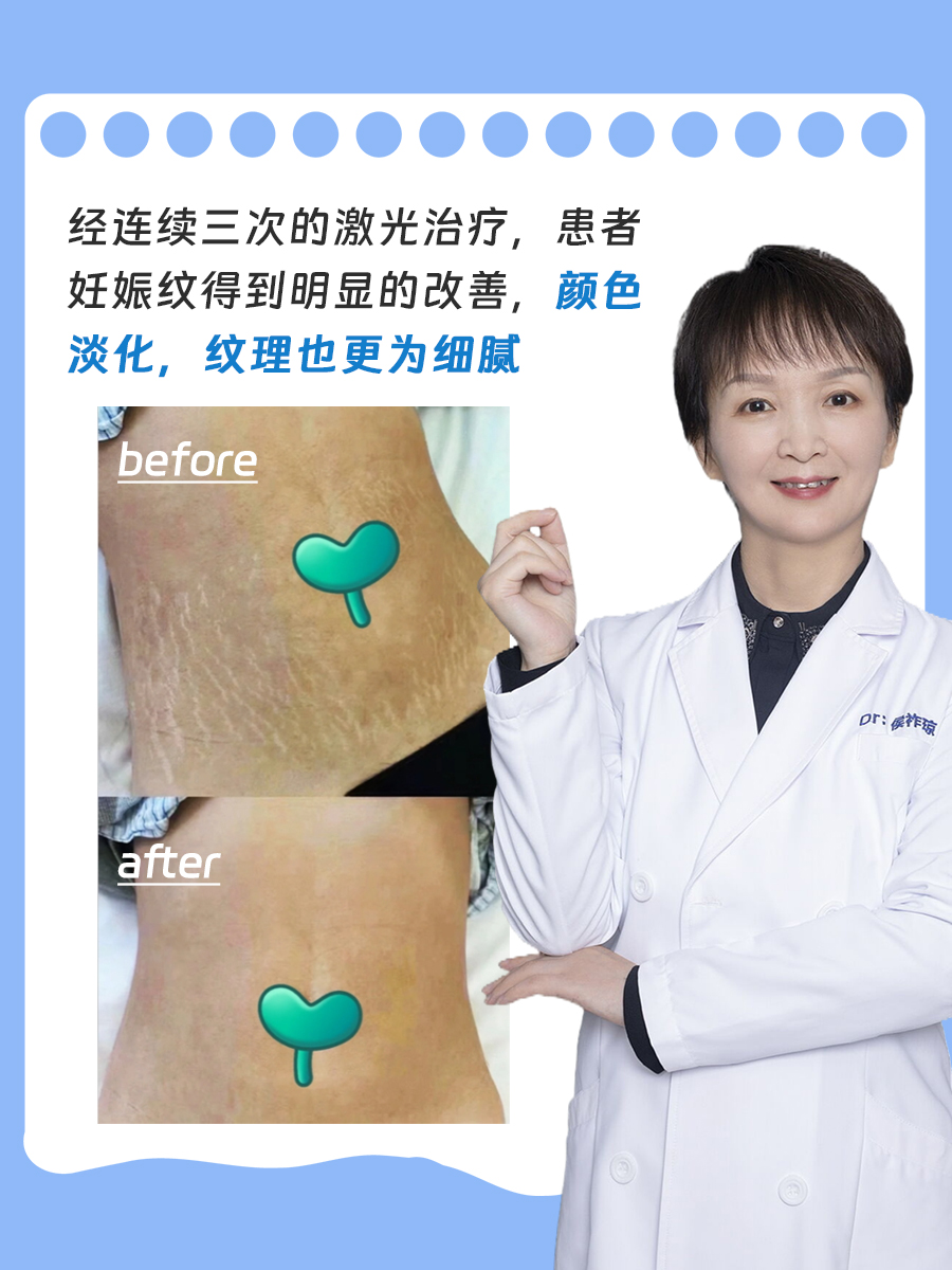 妊娠纹是孕期皮肤受到拉伸,导致真皮层中的弹力纤维和胶原纤维损伤