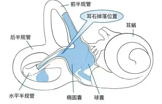 预防耳石症,这些诱因你必须知道!