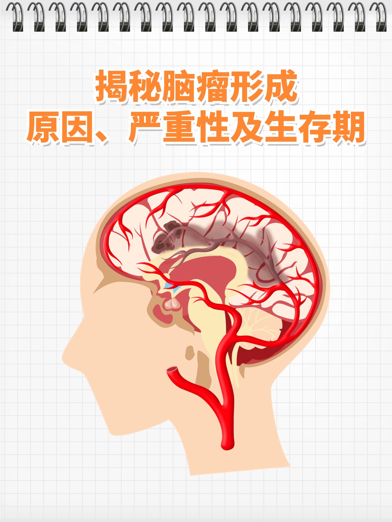 揭秘脑瘤形成:原因,严重性及生存期  我在诊所接待了一位42岁的李女士