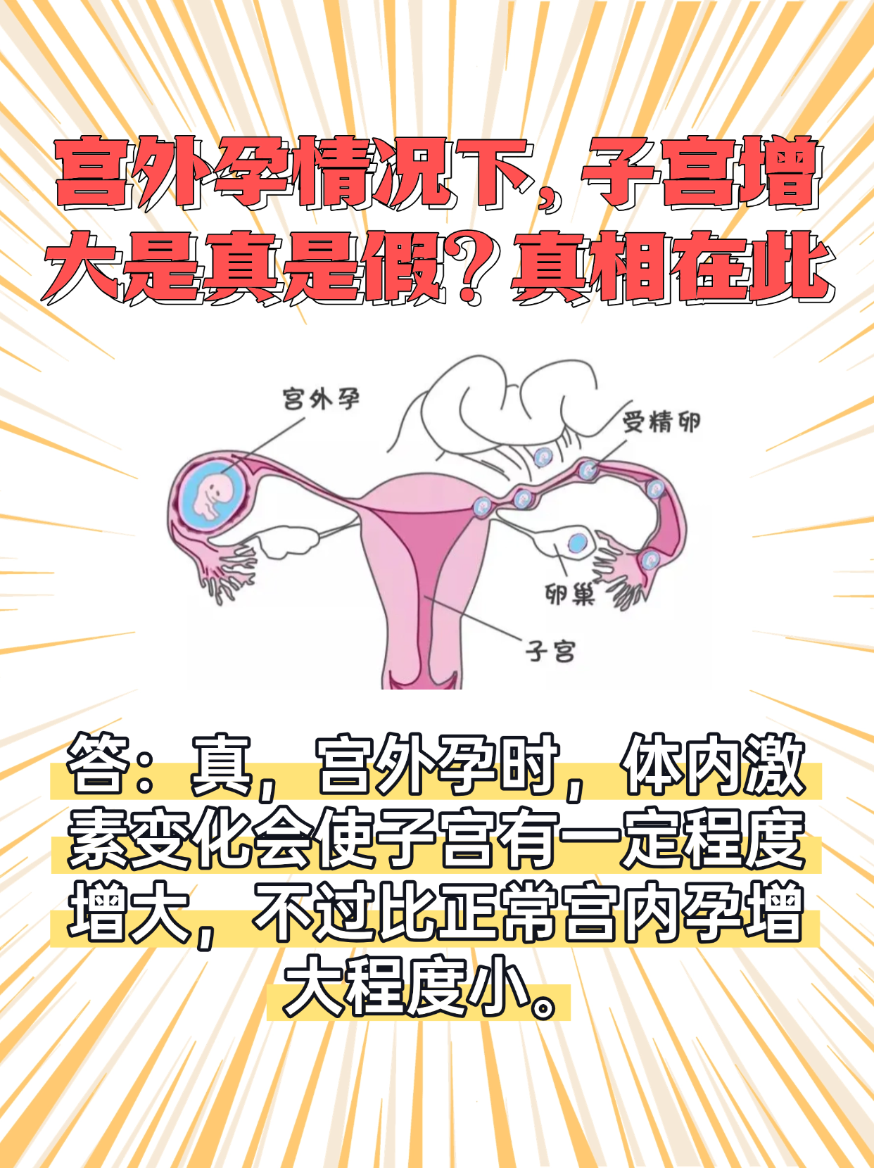 为什么会出现宫外孕