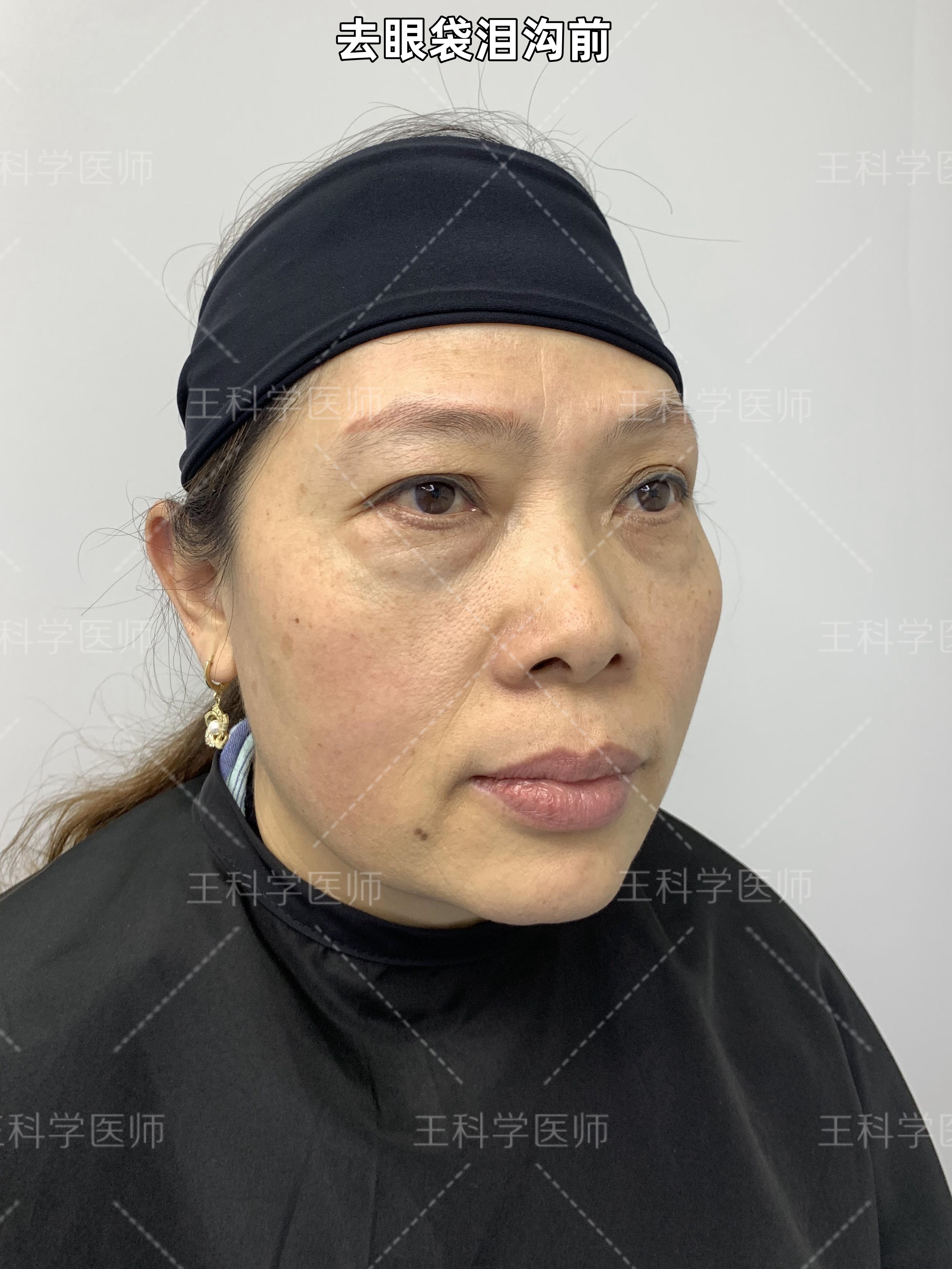 这位求美者52岁,十多年前做过外切眼袋手术,但效果不佳,眼袋,泪沟依旧