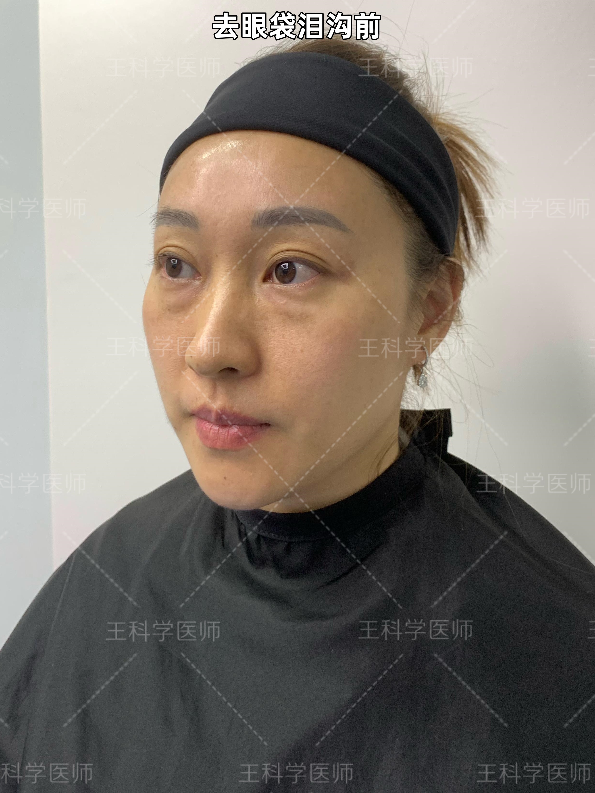 42岁的我,分享祛眼袋两个月后的真实感受,都是真心