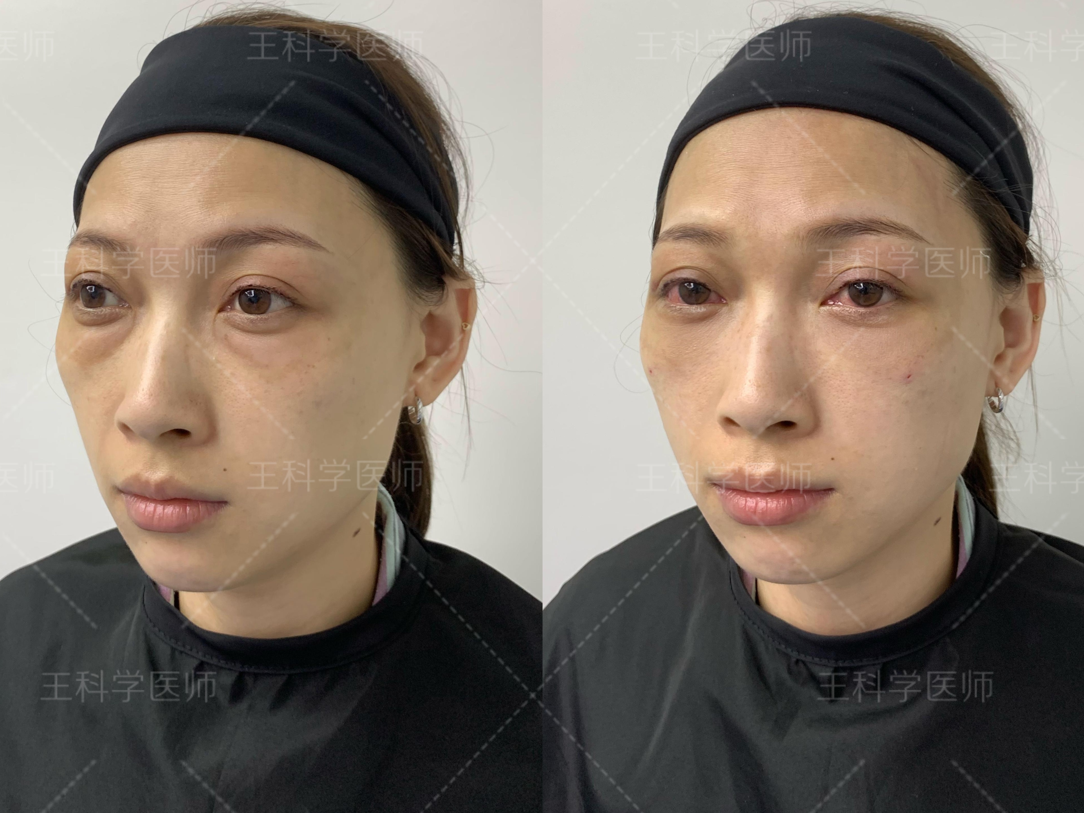 眼袋除了本身显老,还有一种感觉是:眼下凹陷,其实根