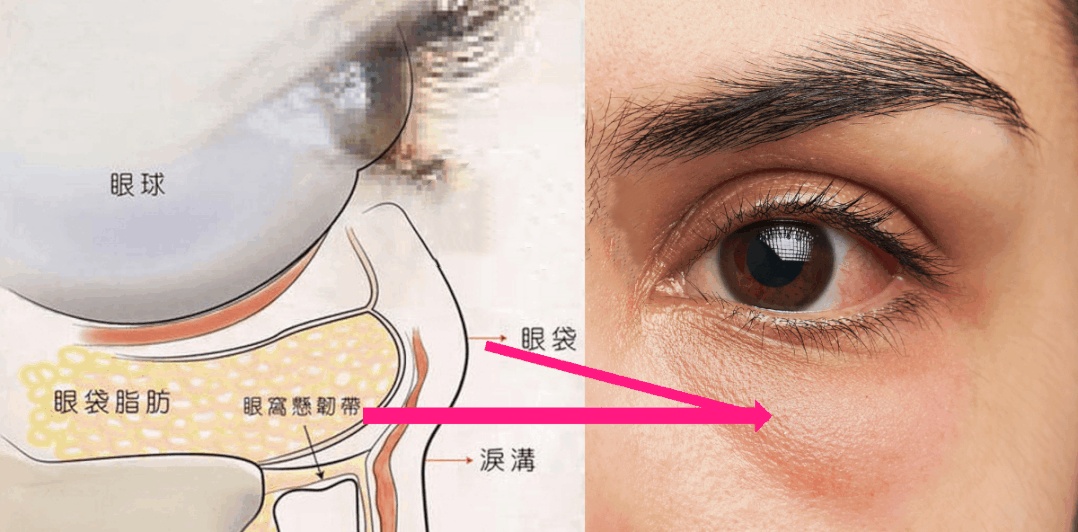 眼袋图片 示意图图片