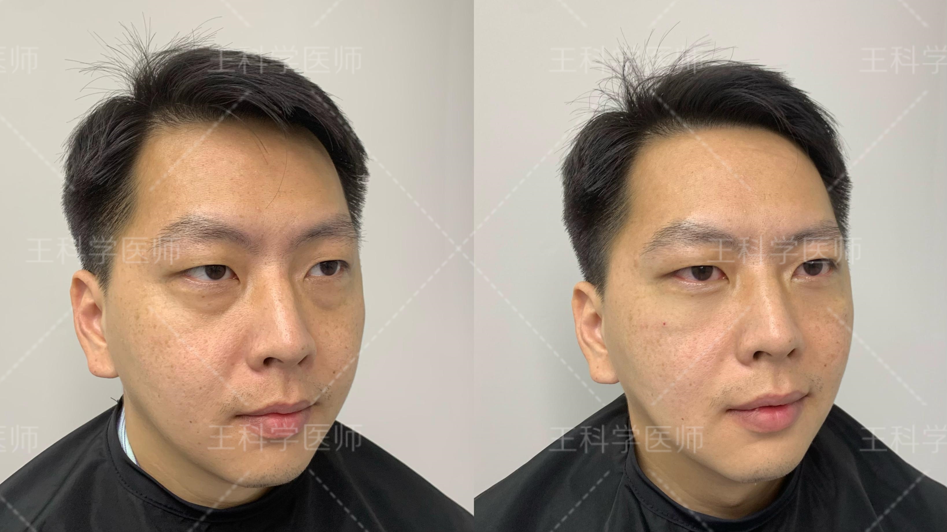 这位求美者35岁,术前他的眼部问题非常典型:眼袋脂肪