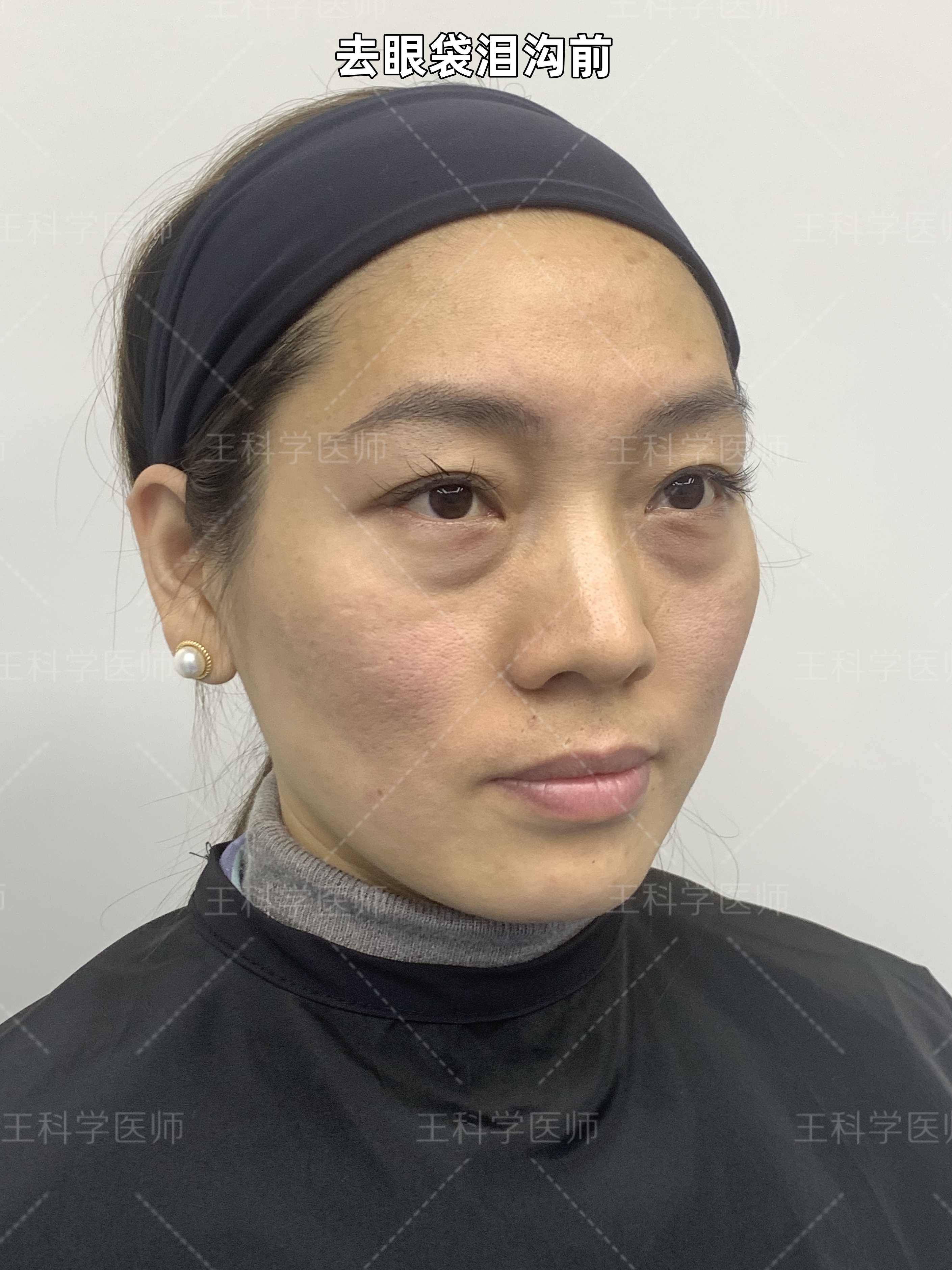 37岁,花20分钟去做眼袋手术,大家看看这效果值不值?