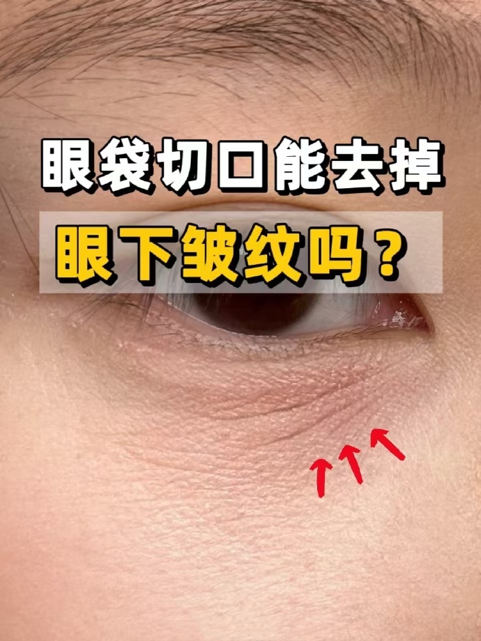 眼纹眼下皱纹切除后图片下眼袋有一道很明显的斜线外切眼袋明不明显
