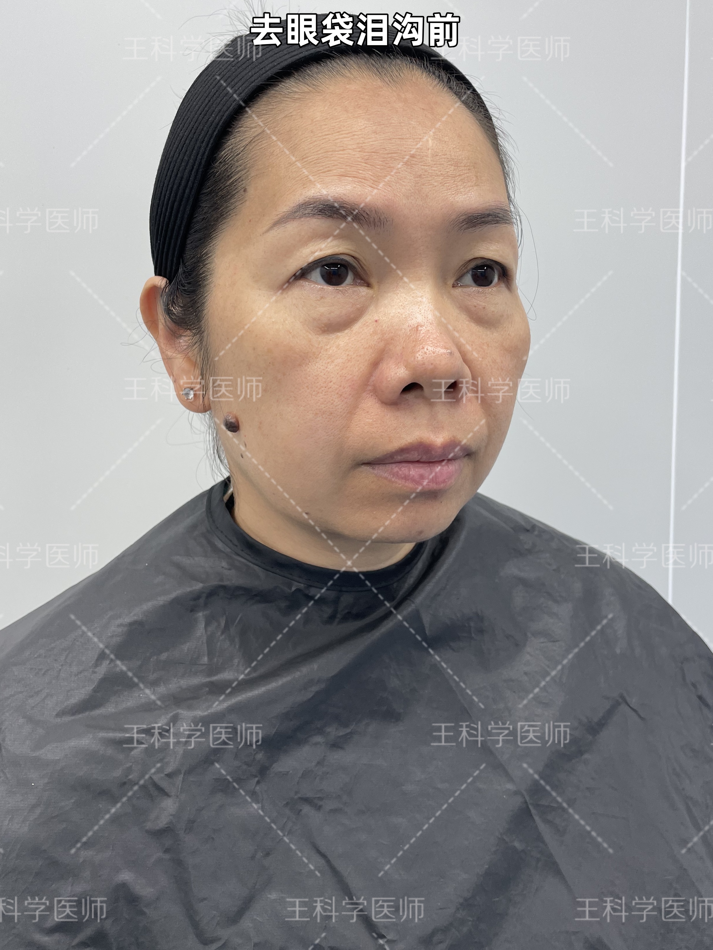 50岁大姐不顾女儿反对执意来做眼袋+提眉手术术后15天颠覆形象