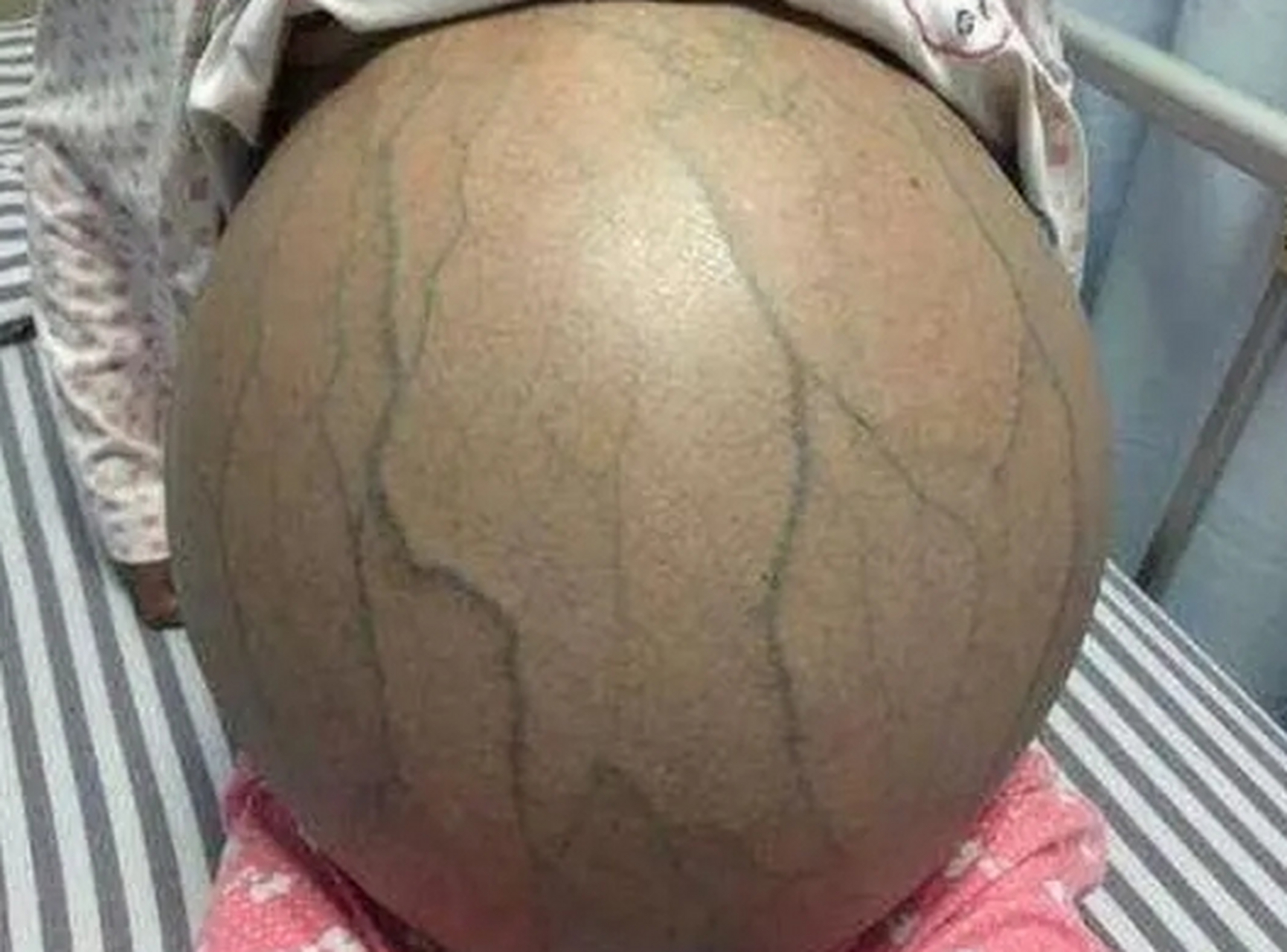 患者咨询:王主任你好,我母亲去年确诊的肝硬化腹水,抽完腹水没过几天