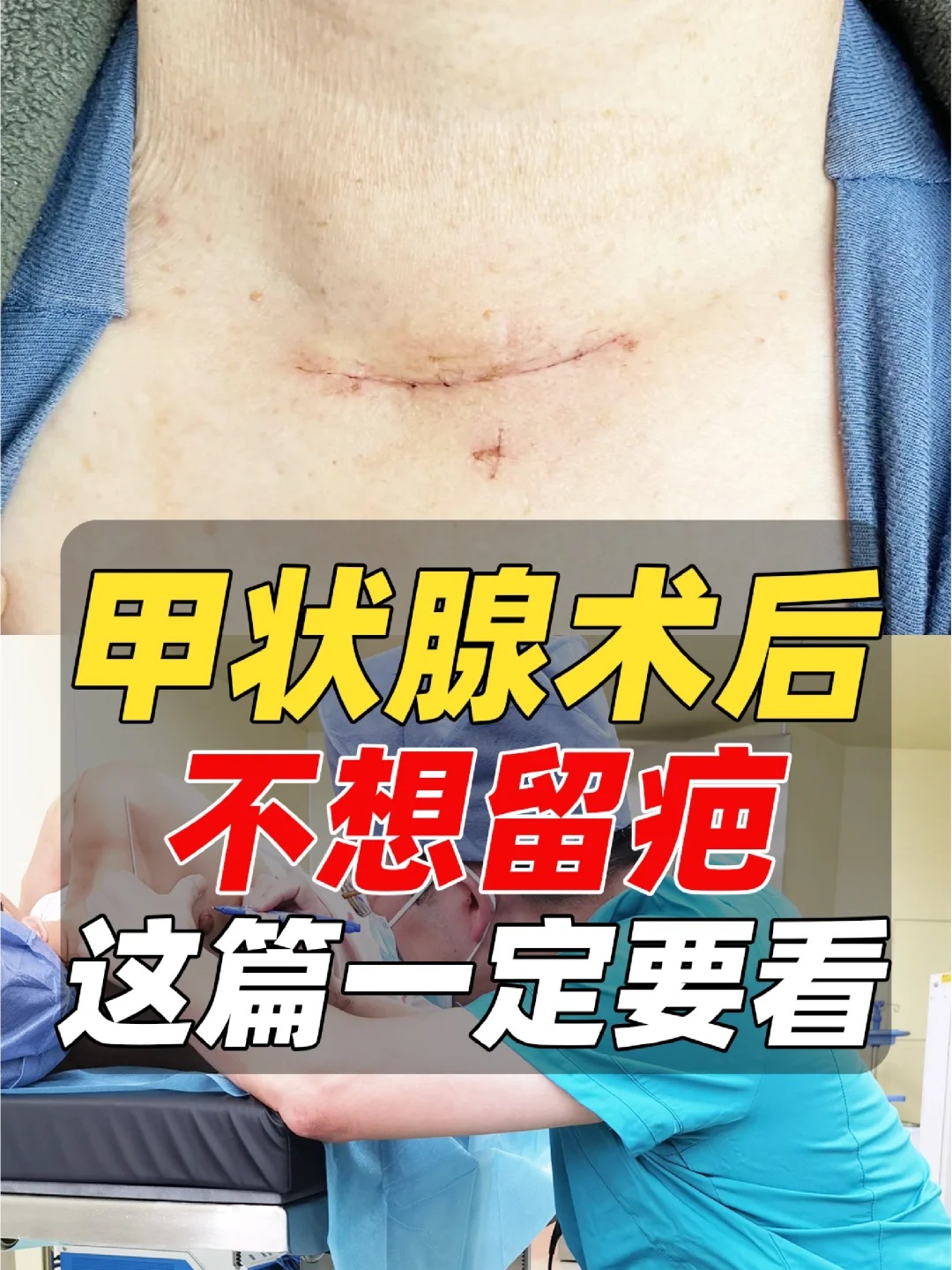 超全甲状腺术后护理不留疤攻略,一定要看