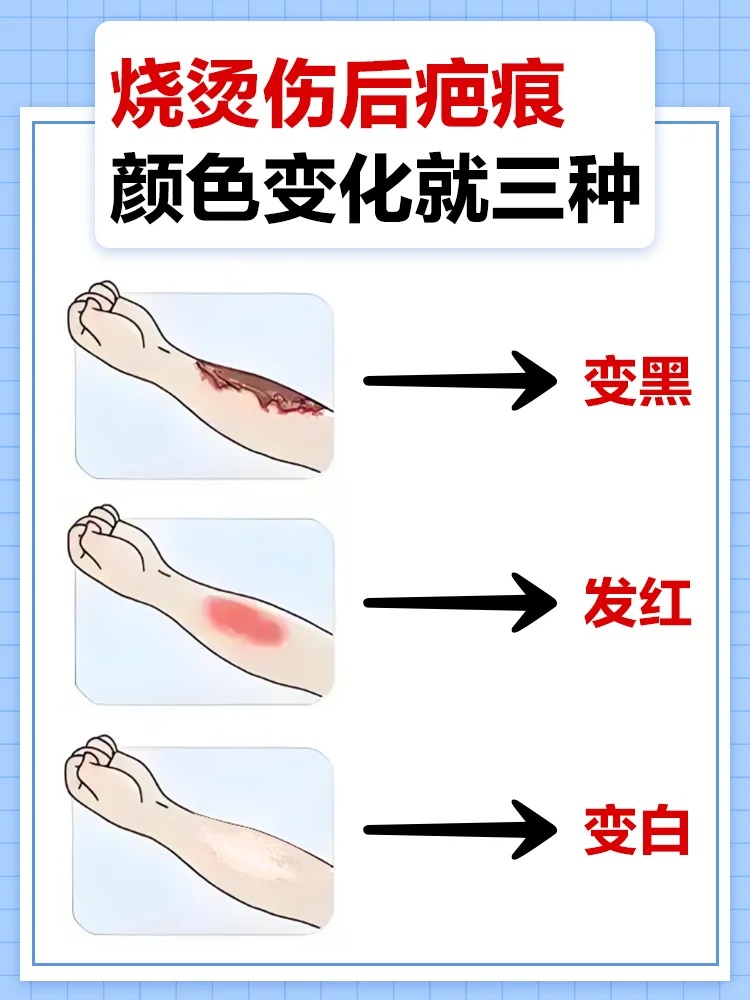 烧烫伤后疤痕颜色就三种变化  很多烧烫伤后就很担心留疤怎么办?