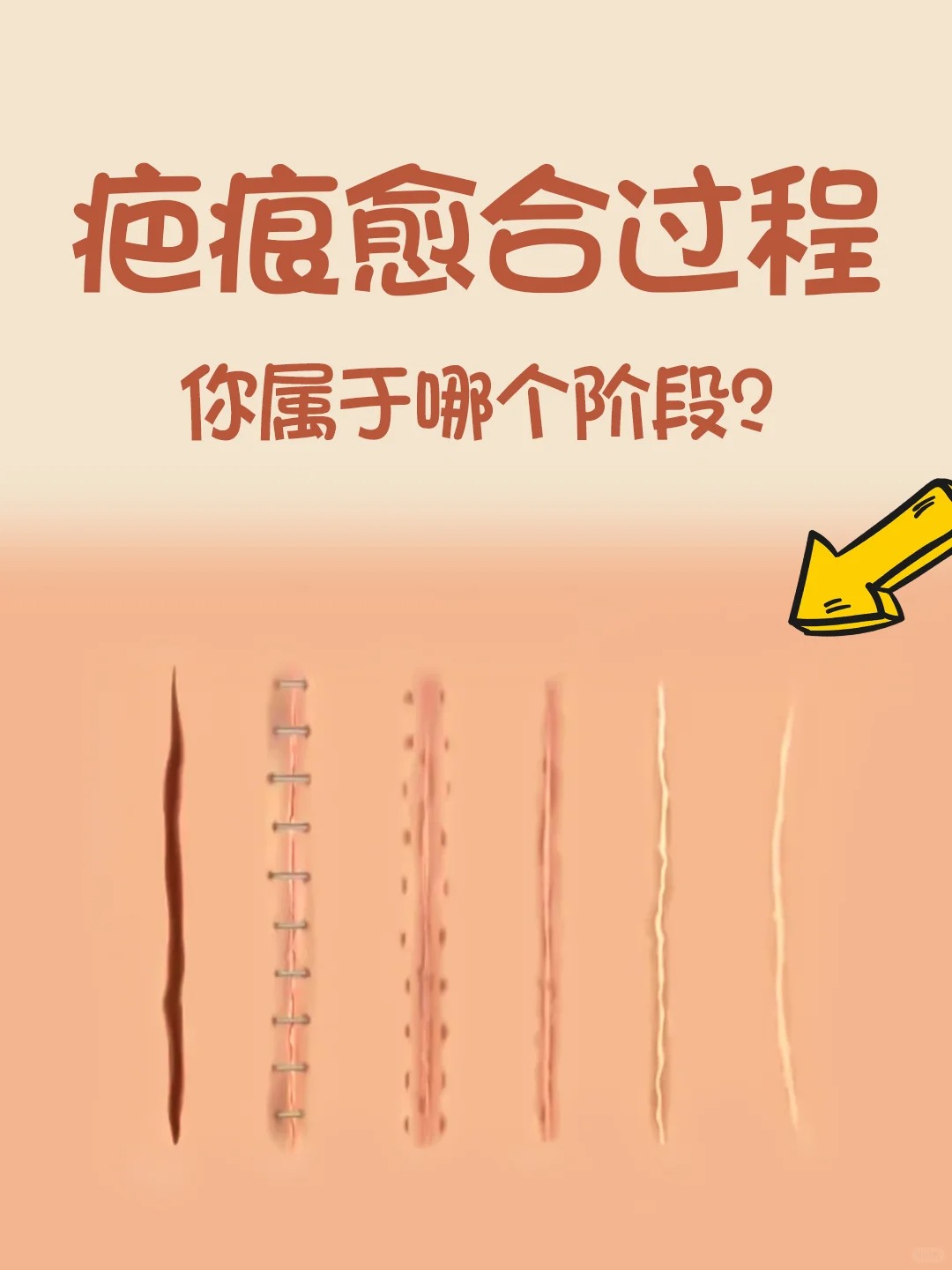 疤痕愈合过程一般会经历哪几个阶段?