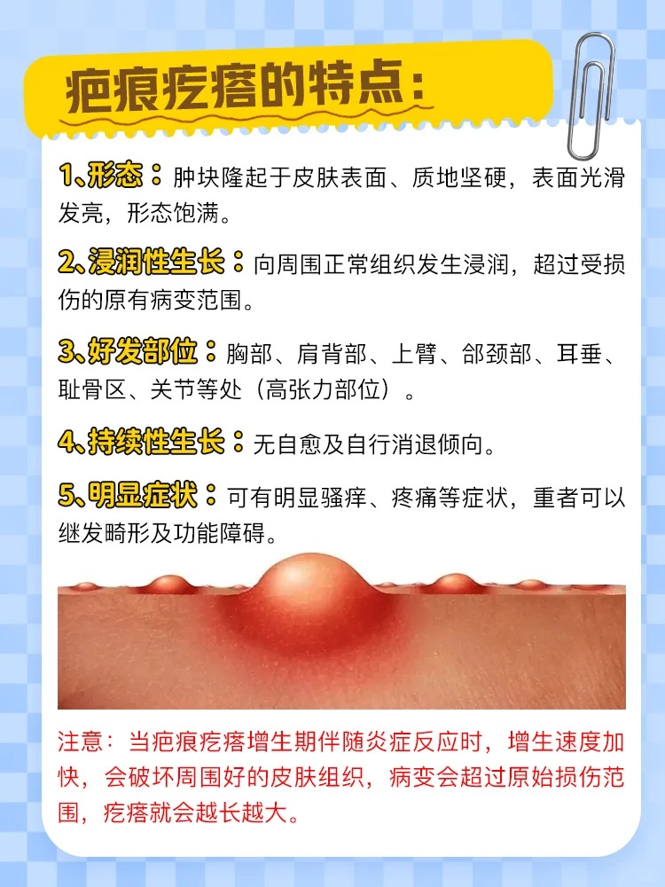 疤痕疙瘩,是皮肤受创或不明原因所致皮肤损伤愈合后所形成的过度