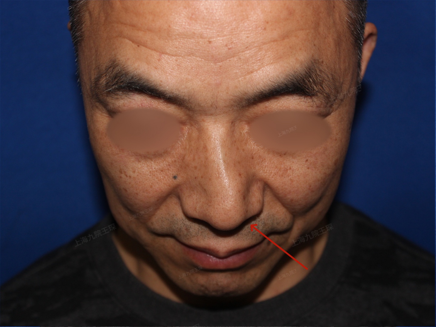 男性鼻歪总在意能做到 "绝对正" 吗