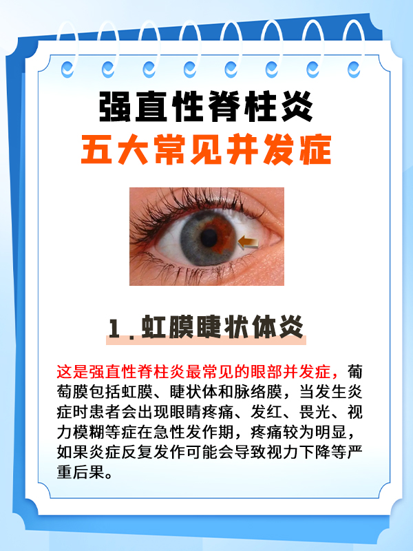 强直性脊柱炎,5大常见并发症!#强直# #强直性脊柱炎