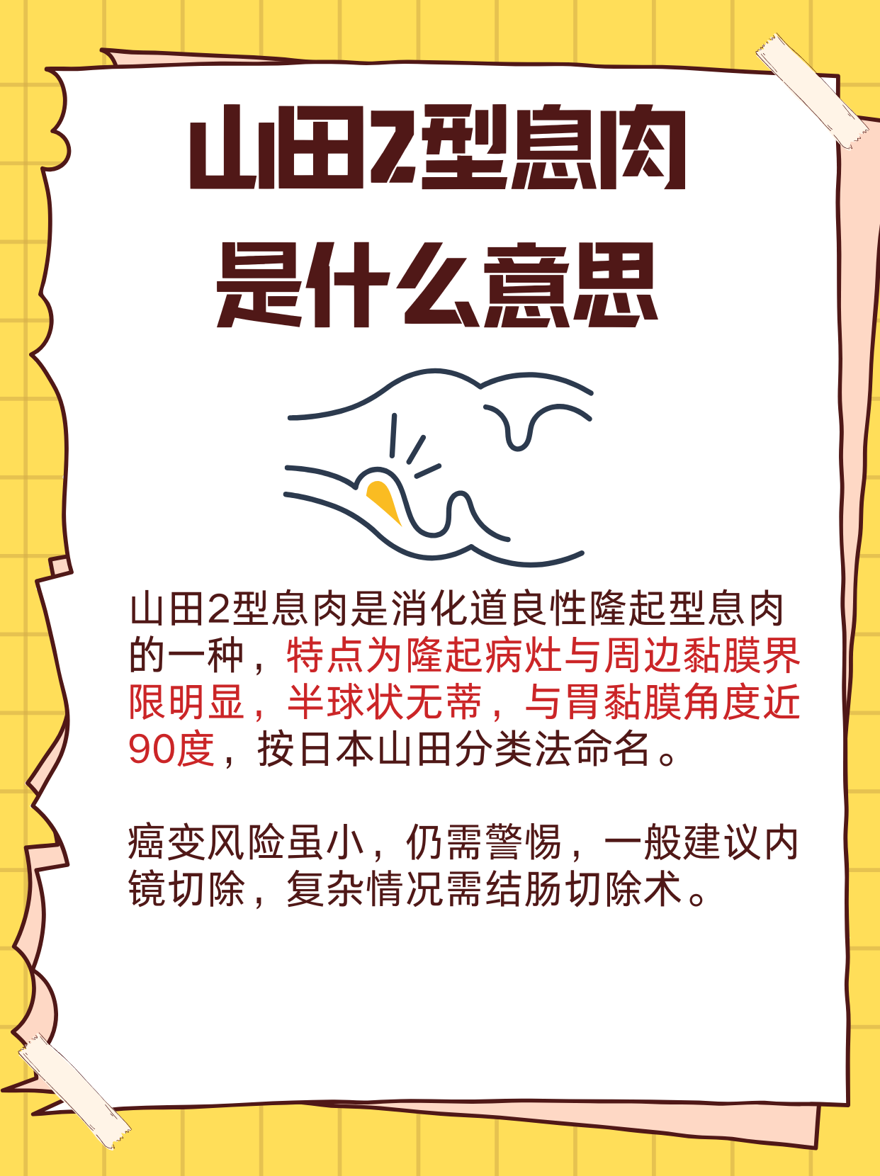 山田2型息肉,其实是消化道良性隆起型息肉的一种分型