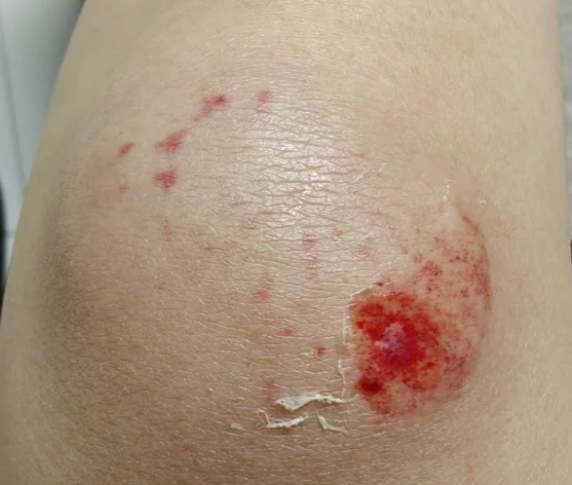 磕伤是日常生活中常见的意外伤害,处理时需要注意以下