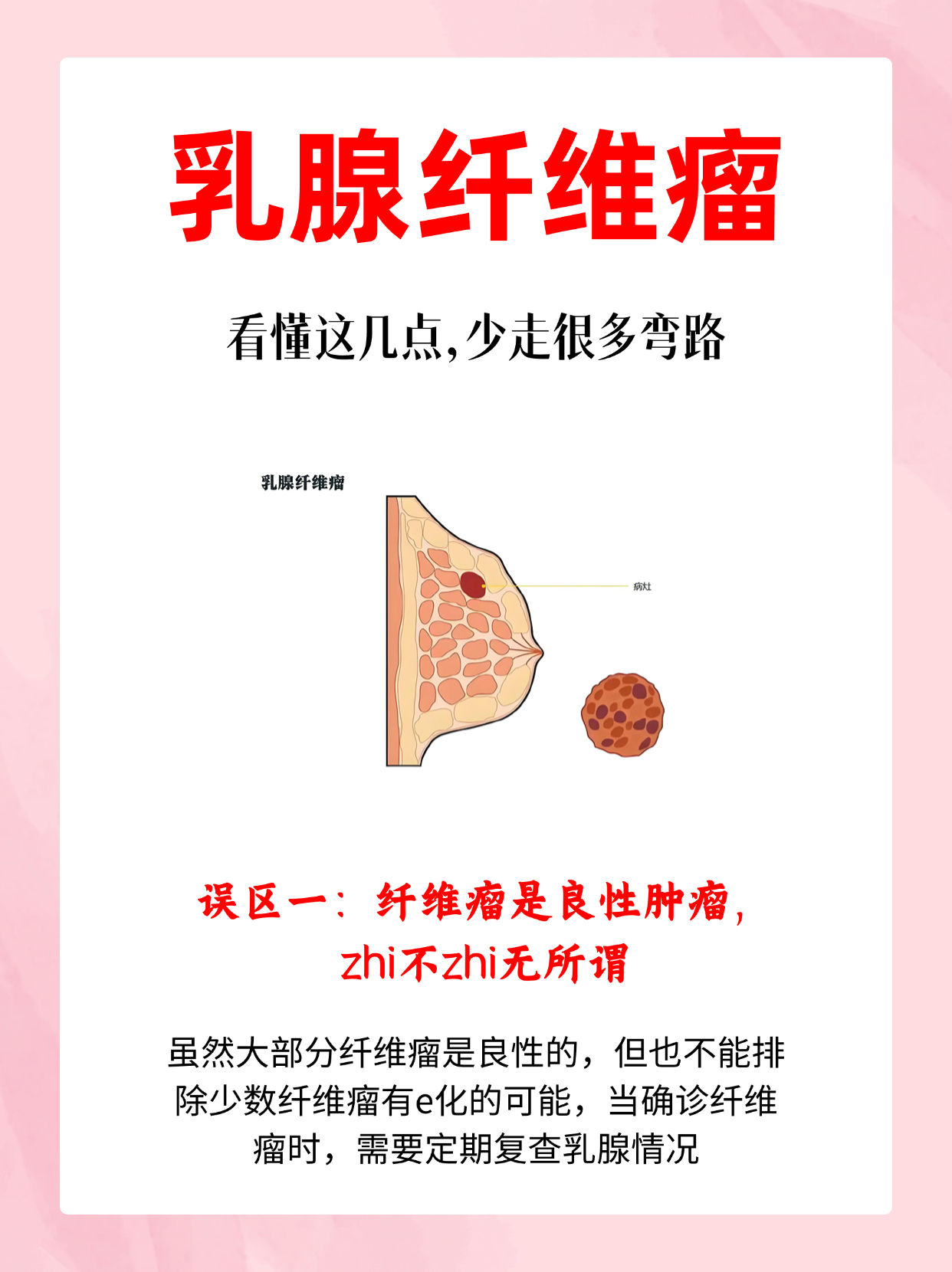 乳腺多发性纤维瘤图片