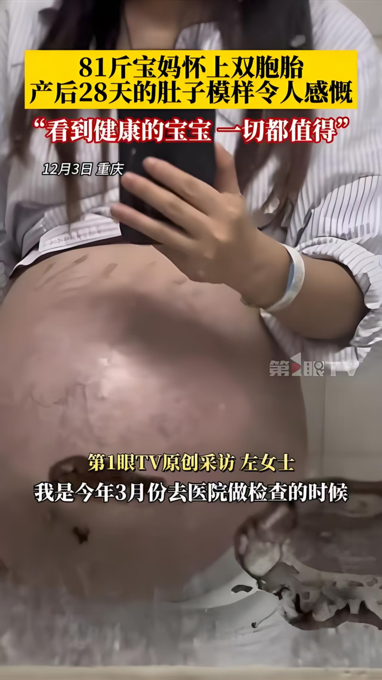女子怀双胞胎儿子时变"悬浮肚",肚子被撑大,产后肚子十分松垮并有妊娠