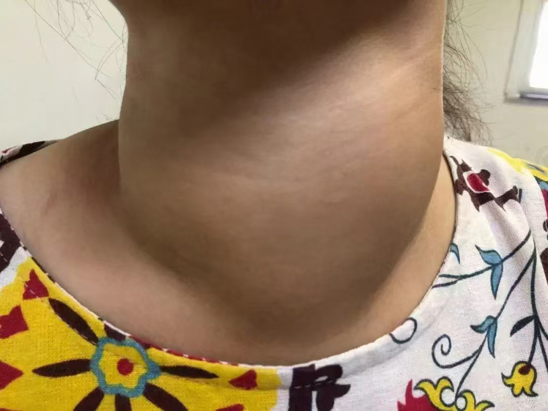 今天来了一名病龄8年的甲亢患者,脖子肿大iii度