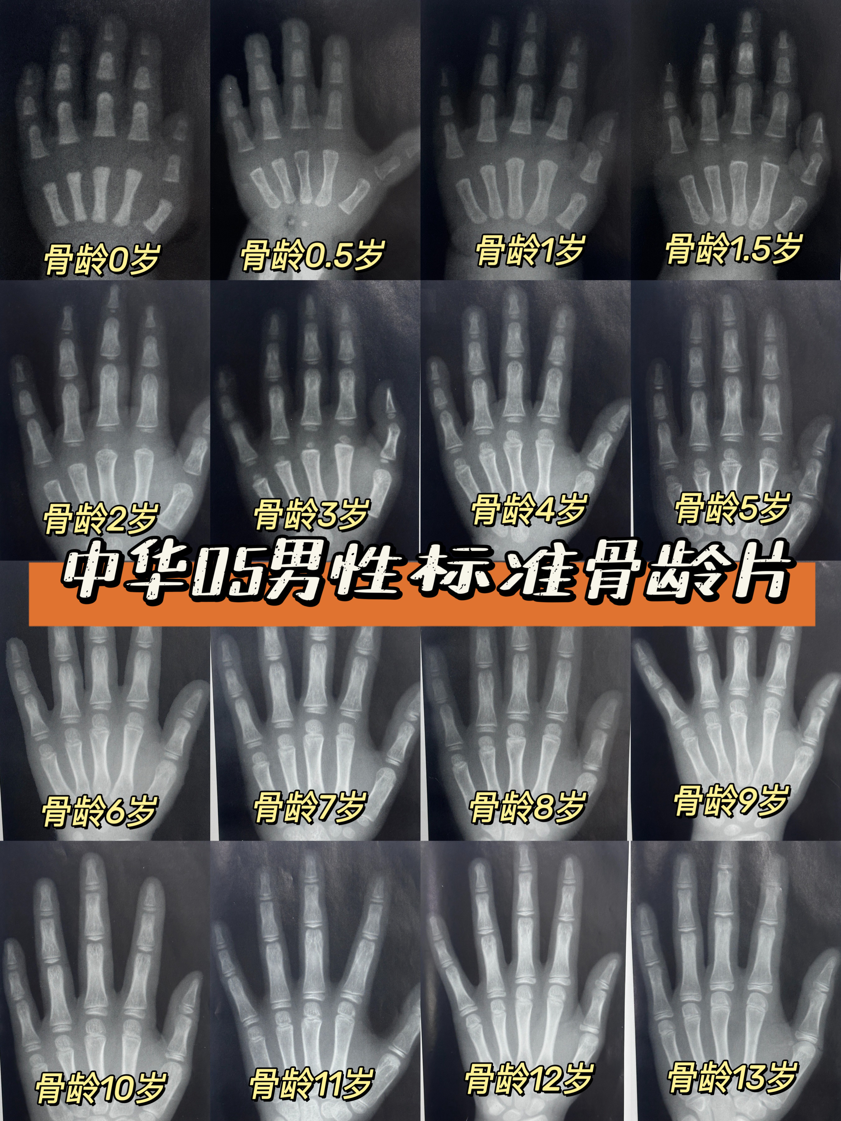 男孩骨龄片对照表,看看你家孩子骨龄正常吗?