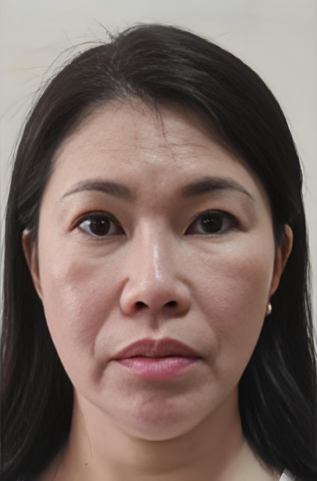被裹挟上了手术台做完才知道我做了一个假拉皮