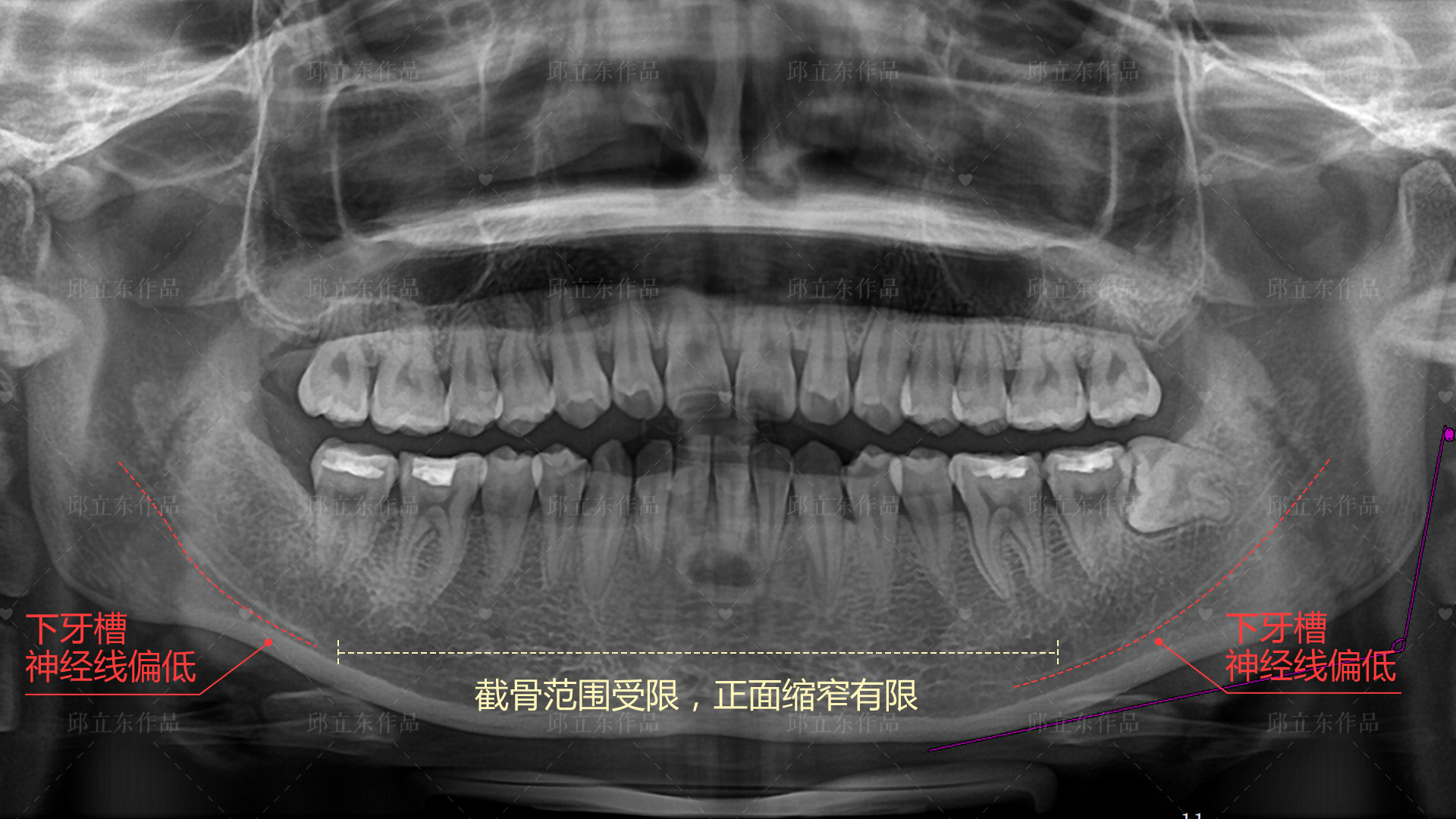 但神经线偏低,下颌骨ct岩骨锥体角下颌骨颏孔x线腮帮子骨密度ct颧骨颧