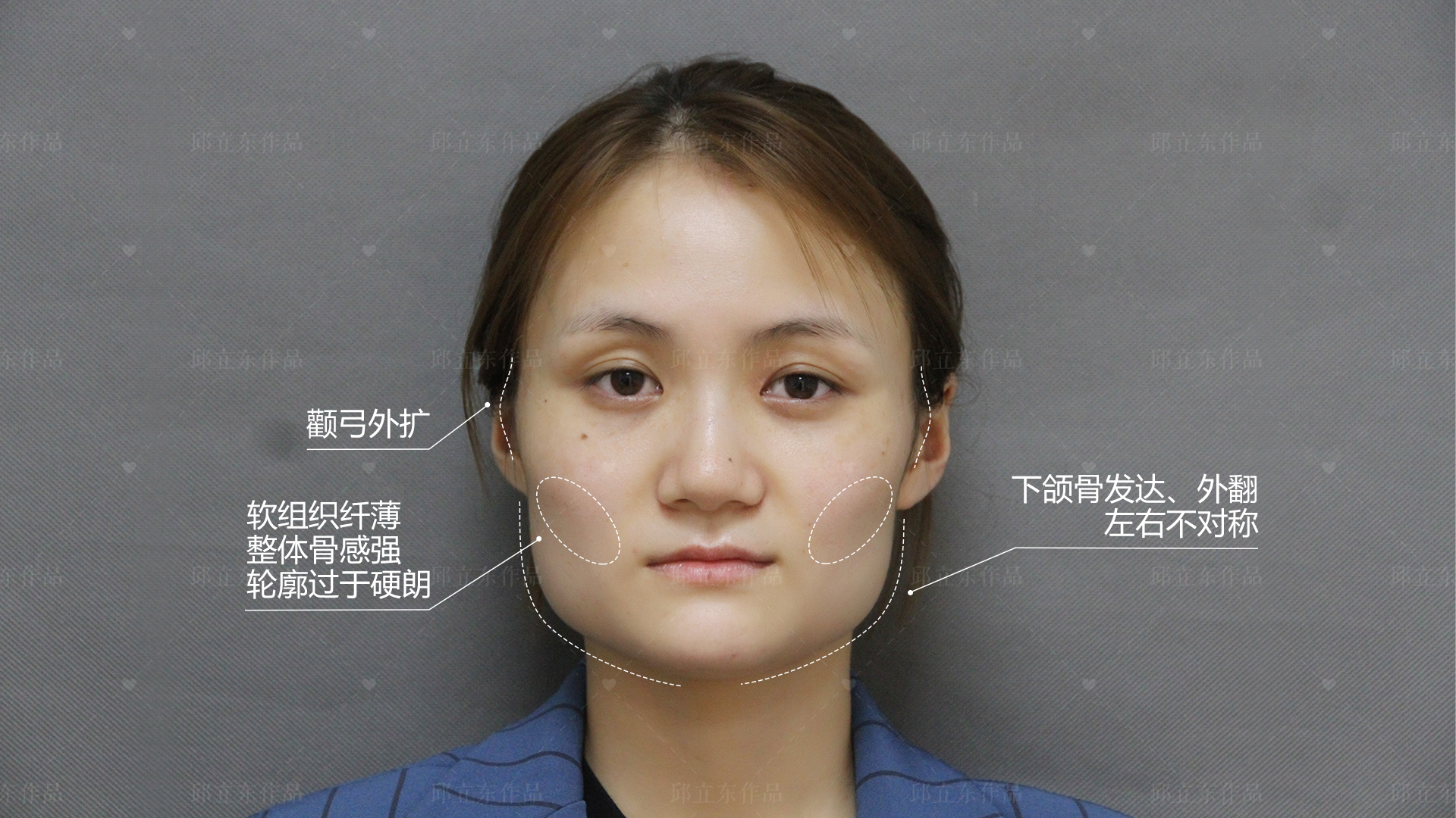 腮骨横哭面部骨骼调整图片女生太瘦的脸型图片颚骨内推前后对比骨骼型