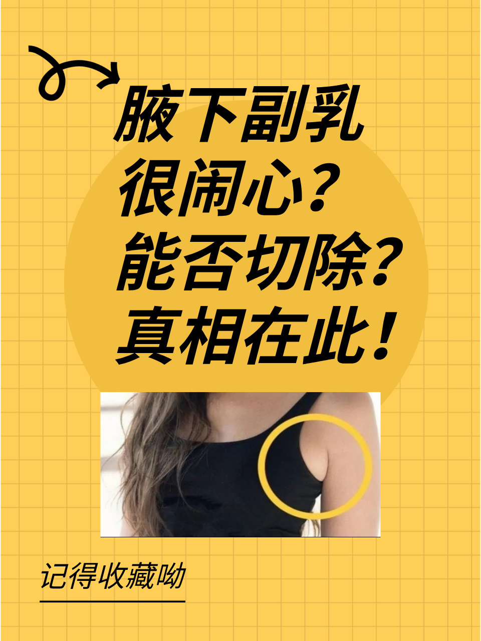 怎么判断是否有副乳图片