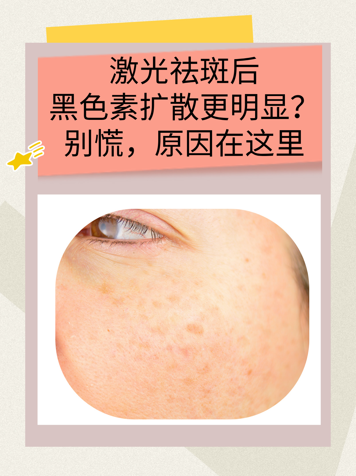 别慌原因在这里 在追求白皙无瑕肌肤的路上很多人都被色斑困扰激光