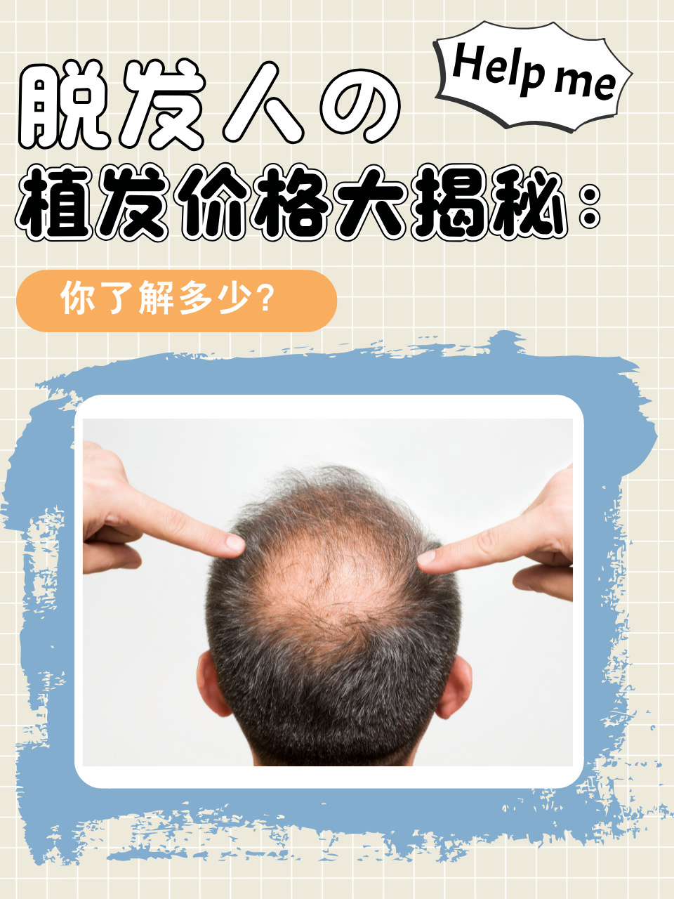 植发是指通过移植自体毛囊,让脱发区域重新长出头发的一种方法