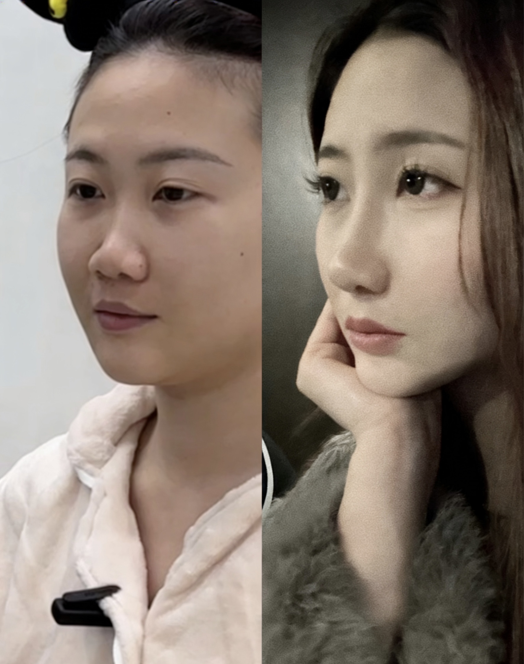 山根低的面相蒜头鼻隆鼻前后对比做假体鼻子的照片大全塌鼻梁隆鼻前后