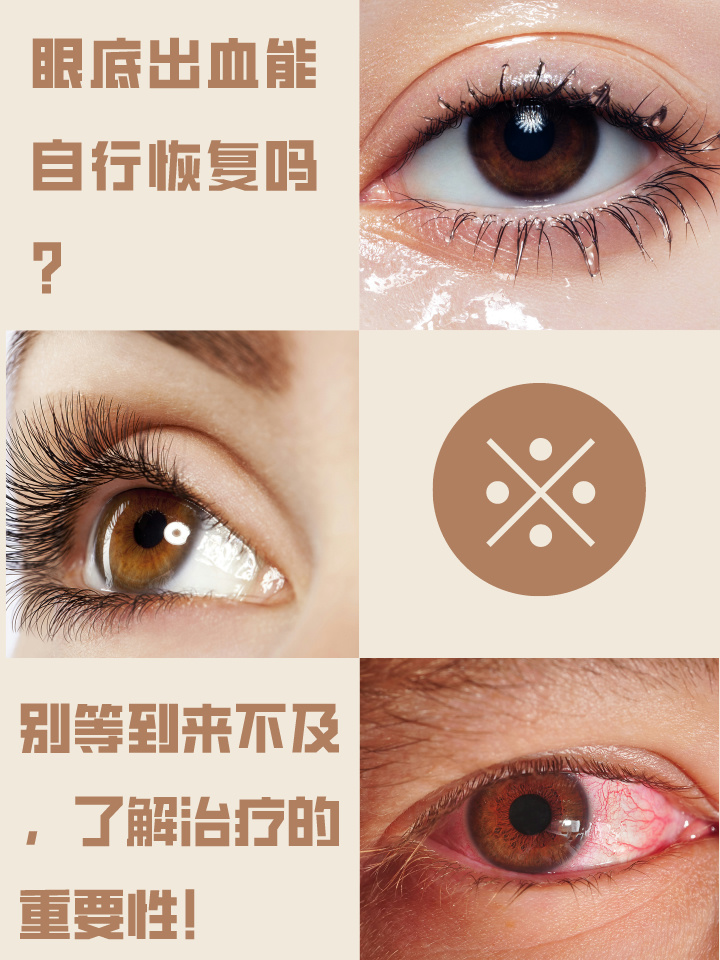 眼底出血能自行恢复吗?别等到来不及,了解治疗的重要性!