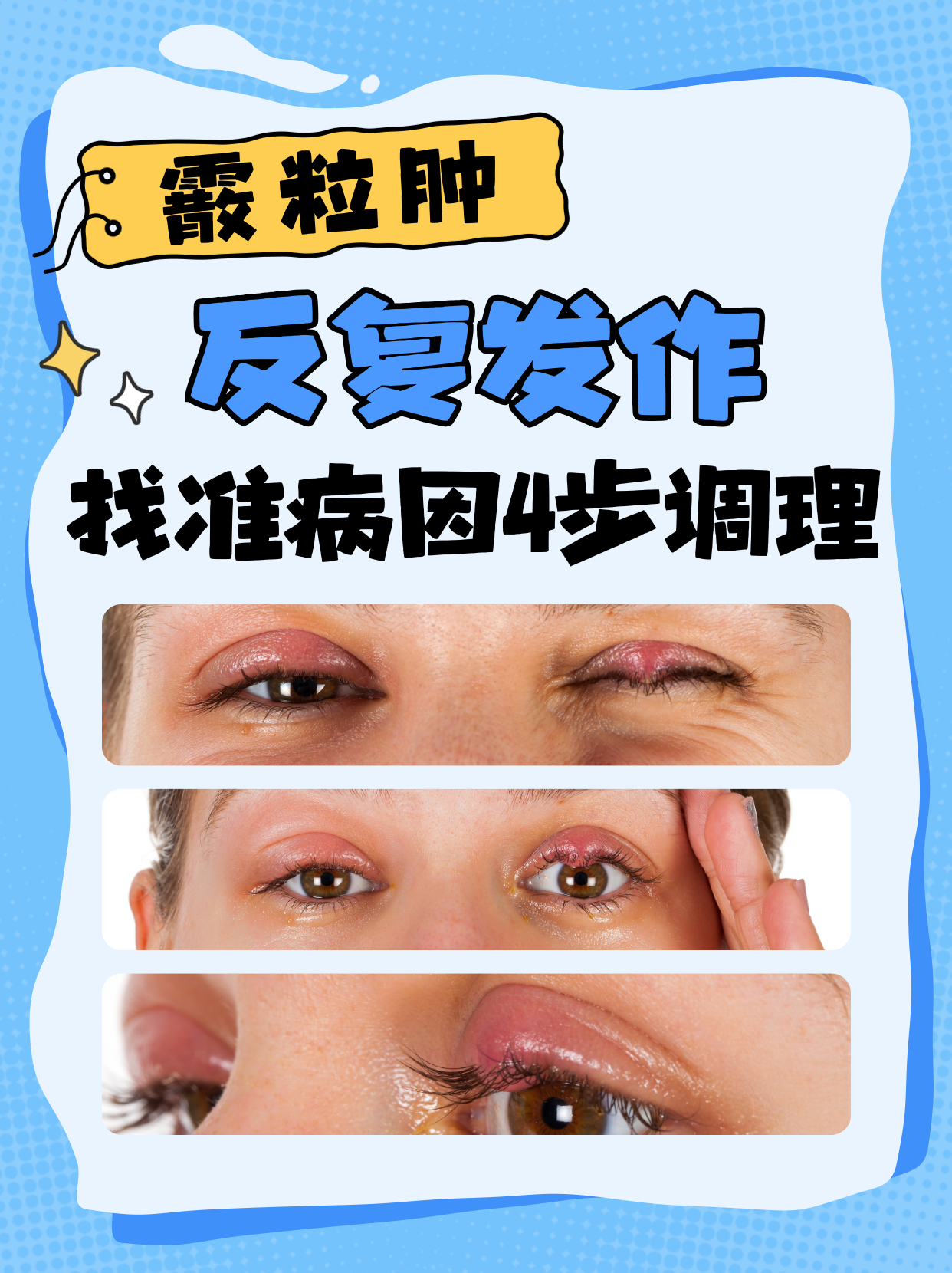 霰粒肿是一种常见的眼部问题,表现为眼皮上出现无