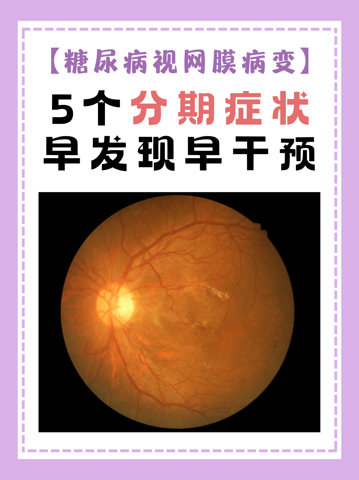 了解它的分期症状,才能在疾病发展过程中抓住干预时机.接下来为大家