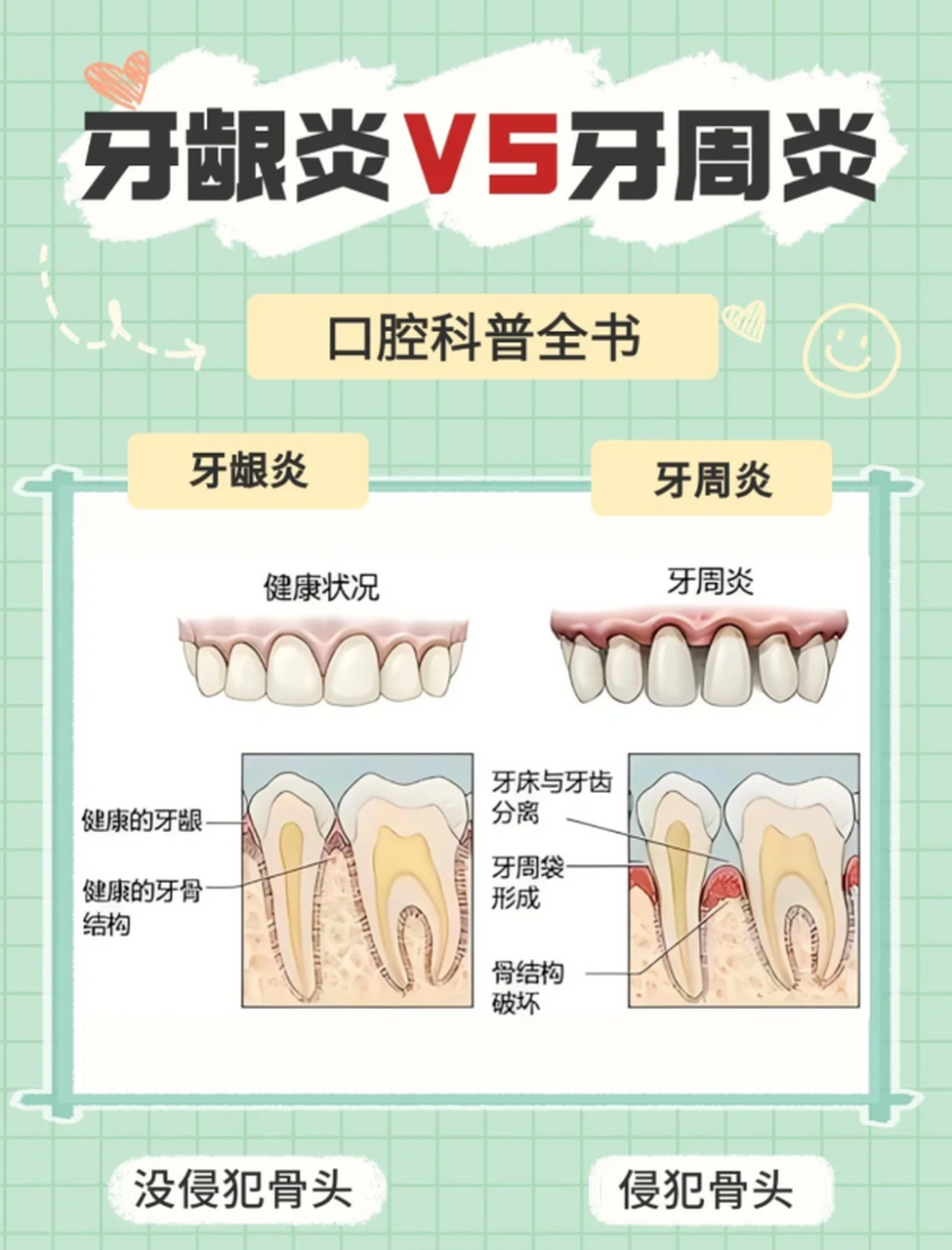 牙龈炎图片大全图解图片