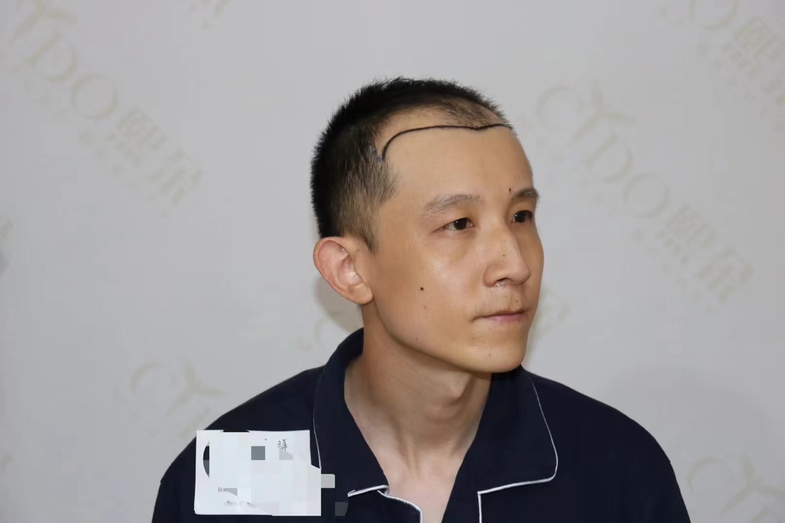 动态连更挑战# 这位男士曾经因为天生的m型发际线