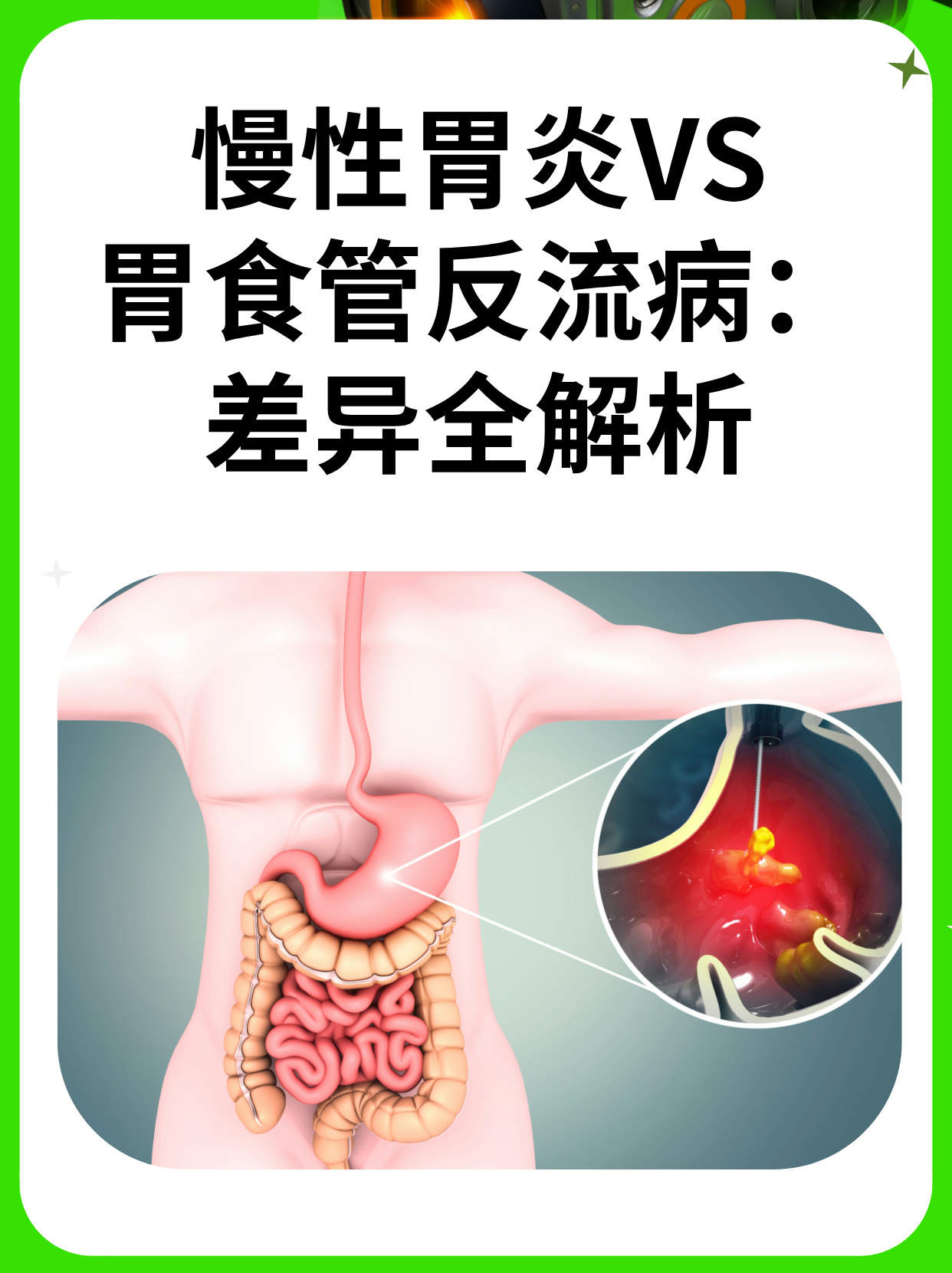 幽门梗阻的症状及治疗图片